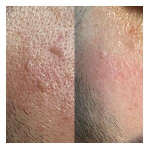 韓國碳化無疼脫尤/油脂粒 (全面任脫 - 體積2mm直徑或以內)/每粒