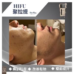 DerMax Hifu 面部提拉療程-體驗價
