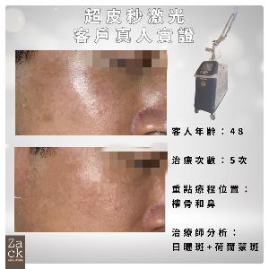 PICO Laser 面部嫩膚療程-體驗價