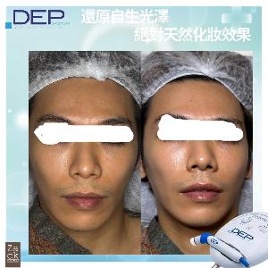 D.E.P 無針肌底水光療程-體驗價