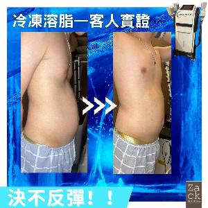 Cryolipolysis 冰感定位纖脂療程(1格)-體驗價