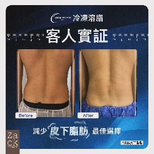 Cryolipolysis 冰感定位纖脂療程(2格)-體驗價